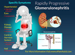 Acute Glomerulonephritis Symptoms Google Search Pediatric Nursing Nursing Fun Fibromyalgia