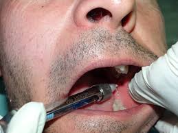 Image result for Local Skin Anesthesia