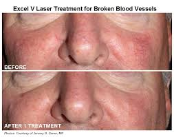 How to get rid of blood blisters. A New Effective Approach To Treating Rosacea Or Facial Redness Skincare Physicians