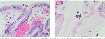 Sansele gravidelor de a contracta infectia bacteria care cauzeaza infectia este sensibila la caldura, asadar gatind mancarea bine, bacteria se. Sarcina Ventricularis Complicating A Patient Status Post Vertical Banded Gastroplasty A Case Semantic Scholar