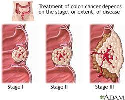 Colon Cancer Multimedia Encyclopedia Health Information St Luke S Hospital This test can find cancers in the early, most treatable stage.