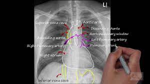 Maybe you would like to learn more about one of these? Chest X Ray Normal Chest X Ray Interpretation Normal Anatomy On A Cxr Youtube