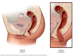 Image result for Rectal Prolapse