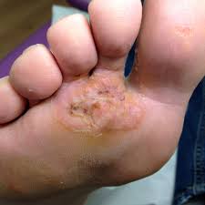 Image result for verruca