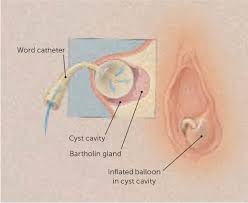 Image result for Bartholin's gland abscess