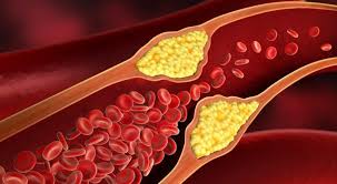 Wie Kann Man Cholesterin Naturlich Senken So Klappt S Herold At Cholesterin Naturlich Senken Cholesterin Senken Rezepte Cholesterinarme Ernahrung