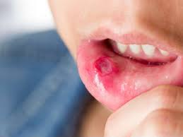 It can be a symptom of throat cancer as cancer can lead to a narrowing of the passages of the mouth, throat, or esophagus. à®‡à®¨ à®¤ à®†à®± à®…à®± à®• à®± à®‡à®° à®¨ à®¤ à®•à®Ÿ à®Ÿ à®¯à®® à®‰à®™ à®•à®³ à®• à®• à®ª à®± à®± à®¨ à®¯ à®‡à®° à®• à®• à®© à®…à®° à®¤ à®¤à®® à®š à®• à®ªà®£ à®£ à®• à®• à®™ à®• 6 Signs You May Have Cancer Tamil Boldsky