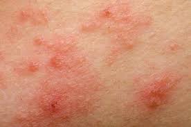 Pin On Autoimmune Disease