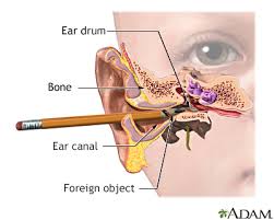 Then tilt your affected ear toward the ground. Ear Emergencies Information Mount Sinai New York
