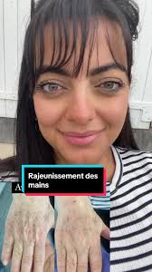 rajeunissementnaturel #rajeunissement #acidehyaluronique #injections ...