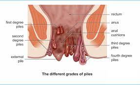 Haemorrhoids During Pregnancy Prevention And Treatment