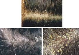 Extreme dandruff can be caused when bacteria and fungi grow on the scalp, causing an annoying itching and the formation of dry skin flakes on the hair. A Practical Guide To Scalp Disorders Sciencedirect