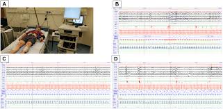 2, 2019/2020 pelajar 1st intake: Adaptive Servo Ventilation Therapy Does Not Favourably Alter Sympatho Vagal Balance In Sleeping Patients With Systolic Heart Failure And Central Apnoeas Preliminary Data International Journal Of Cardiology