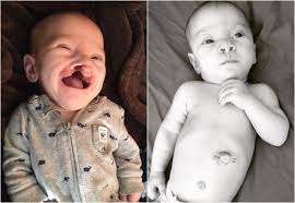 Criança vítima de preconceito recebe doação anônima para tratamento