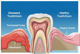 Gingivitis symptoms include painful gums, bleeding while brushing, red gums, swollen gums, tender gums, bad breath and bad taste in mouth. Treatment For Gum Disease In Dallas Periodontal Associates