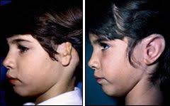 Microtia Atresia Burt Brent Md Brent Burt Hearing Loss