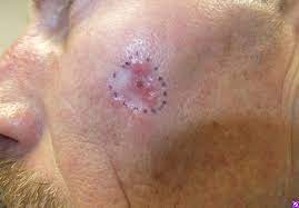 It affects people of all races, genders and ages, which is why it's absolutely critical for americans to learn about. Disease Management Nonmelanoma Skin Cancer