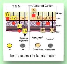 Most colon cancers are adenocarcinomas; Memoire Online Apport Du Dosage De L Ace Dans Le Depistage Et La Prevention Du Cancer Du Colon Fatima Benhamza