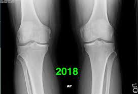 Image result for Knee XRay
