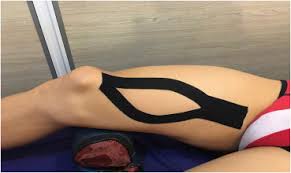 Effects Of Kinesio Taping On Knee Function And Pain In Athletes With Patellofemoral Pain Syndrome Journal Of Bodywork And Movement Therapies