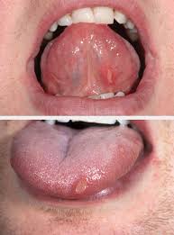 Image result for mouth ulcer on tongue)