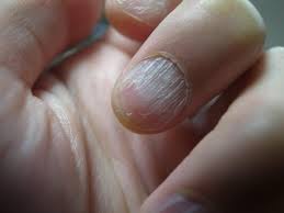 Penn campus hair skin & nail salon location: Dry Hair Skin And Nails Could Point To Underlying Health Problems Wrvo Public Media