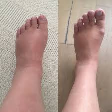 Salam untuk semua pembaca blog saya, sihat hendaknya semua. 6 Tip Kurangkan Kaki Bengkak Ibu Hamil Dr Izzat Bidadari My