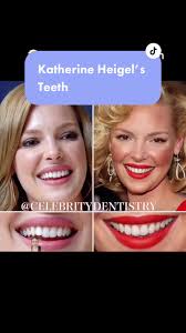 Katherine Heigel’s teeth #veneers #katherineheigl