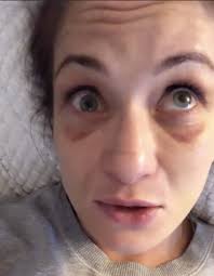 She is the former ksw. Karolina Kowalkiewicz Fait Le Point Sur Les Blessures Aux Yeux Et Subira Une Operation Jeudi Crumpe