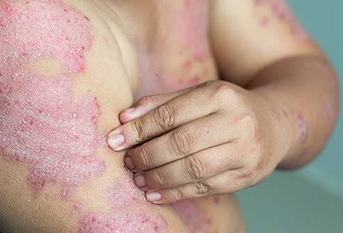Psoriasis treatment