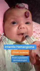 Hemangioma Em Bebê No Pescoço Grande