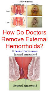 Pin On How To Cure Hemorrhoids