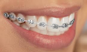 Resultado de imagen para IMAGEN DE BRACKETS METALICOS