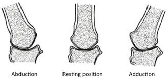 Continued joint narrowing (more than 2. Noncongruence Of The Tmc Joint By Napier Et Al 14 Download Scientific Diagram