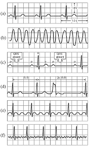 An ecg can provide clues about enlargement of the chambers or walls of. Common Examples Of Abnormal Ecgs 11 A Normal Sinus Rhythm B Download Scientific Diagram