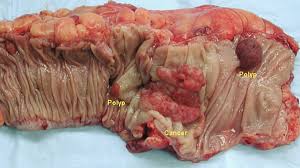 A colon often precedes an explanation, a list, a quotation, or a block quotation. The Answer To A Colon Cancer Mystery Nutritionfacts Org