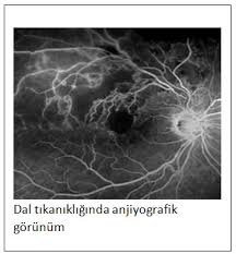 Retinal Ven Toplardamar Tikanikligi Prof Dr Gokhan Gulkilik