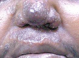 Maybe you would like to learn more about one of these? Airways Disease In Sarcoidosis Intechopen
