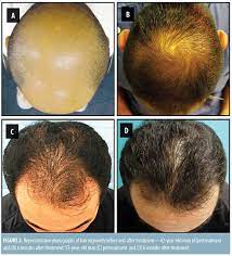 Androgenetic alopecia is a common form of hair loss in both men and women. Androgenetic Alopecia Treatment In Asian Men Jcad The Journal Of Clinical And Aesthetic Dermatology