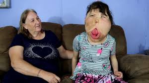 Katie is diagnosed with megalencephaly, a condition that causes an enlarged  brain. Her family often receives comments criticizing them for giving birth  to someone with this disability. Katie's mom just wants others