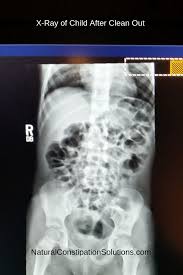 x ray after clean out x ray constipated child bristol stool