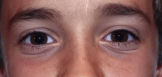 Continue learning about skin disorders Eyelid Dermatitis And Other Dermatologic Conditions Ento Key