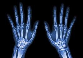 The large majority of these fractures can be easily treated in a cast for about 4 weeks. Clean Up Finger Fracture Coding With This S62 6 Documentation Primer