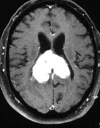 Https Neurologie Uni Bonn De Dateien Bilder Vorlesung Vorlesungneuroonkologie Pdf