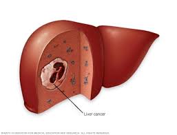 Liver cancer occurs when the liver cells are out of control and the divide and multiply abnormally. Liver Cancer Symptoms And Causes Mayo Clinic