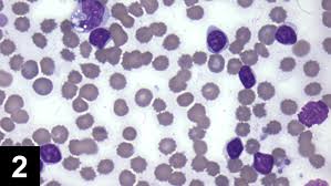 Erythrocyte sedimentation rate hypersegmented cells lymphoma. Top 5 Leukogram Patterns Clinician S Brief