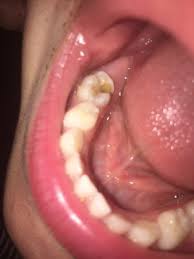 Apr 07, 2021 · apple dental care is located in chicago city of illinois state. Apple Dental Care 2062 N Milwaukee Ave Chicago Il Dentists Mapquest