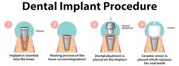 Image result for dental implant