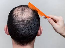 For those of you taking beta blockers, i urge you to look it up. Genetic Vs Reactive Male Hair Loss