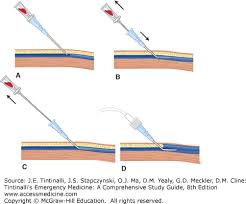 Image result for Peripheral IV Access